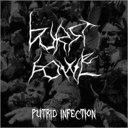 Burst Bowel : Putrid Infection